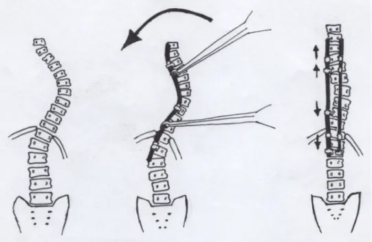 Abbildung 3: Operationsmethode nach Cotrel-Dubousset, modifiziert nach Hefti 
