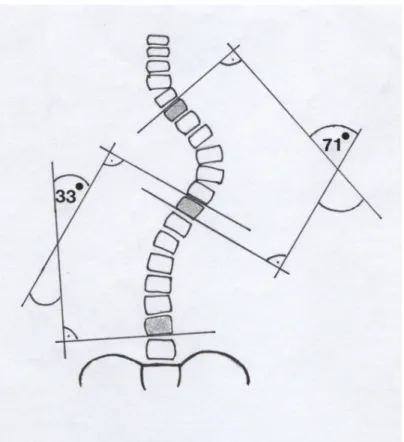 Abbildung 7: Messung der thorakalen und lumbalen Krümmung der Wirbelsäule mit der Methode nach Cobb 