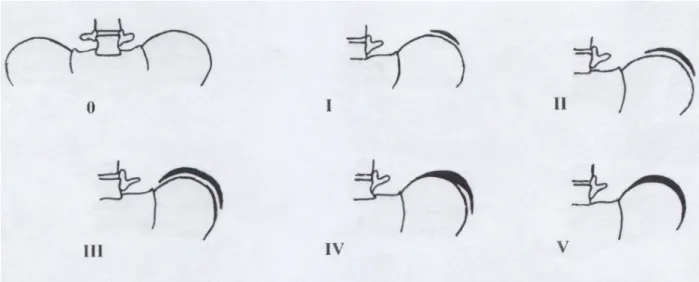 Abbildung 2: Risser-Zeichen: Die Verknöcherung beginnt von lateral zur Zeit des größten Wachstumsschubes  (Risser-Stadium I)