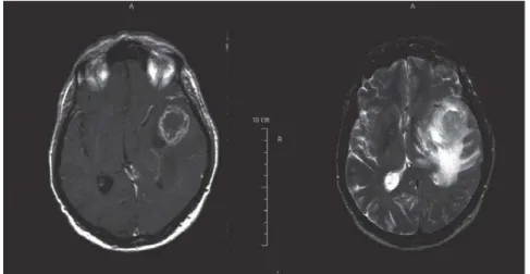 Abbildung  4:  Gezeigt  ist  die  Kernspintomographie  eines  Glioblastoms  in  axialer  Schnittebene  mit  zentraler Nekrose und starker peripherer Kontrastverstärkung sowie einem ausgeprägtem perifokalen  Ödem