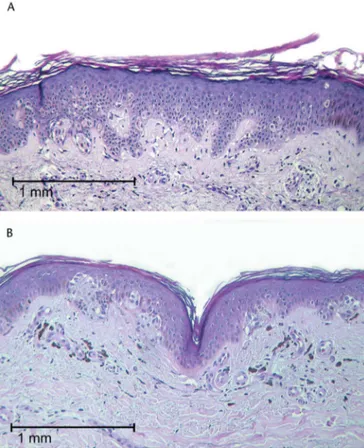FIGURE 1. A, Typical profile of a DN-LW. Such lesions are small, usually ,3 mm, and considerable pagetoid spread and enlarged atypical single cells can be found