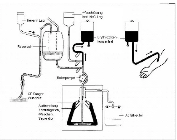 Abb. 4: Ablauf der maschinellen Aufbereitung von Wundblut unter OP-Bedingungen 