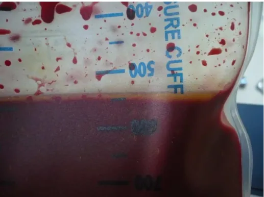 Abb. 1  Fettschicht in einem MAT-Produkt (gewaschenes EK im Transfusionsbeutel) 