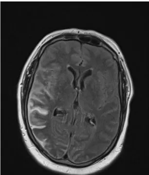 Abb. 2: Rechts temporo-occipital betonte SAB in der MRT (FLAIR) mit deutlich  hyperintenser Darstellung der betroffenen Subarachnoidalräume 
