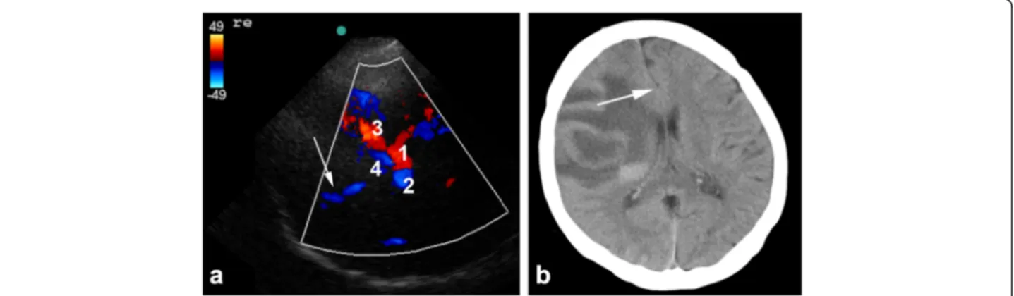 Figure 3 Images obtained in a 54-year-old patient with progressive left-sided paralysis due to a brain tumor