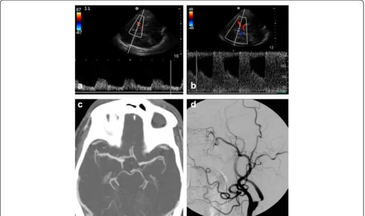 Figure 6 Cross-filling suggestive of high-grade stenosis or occlusion of the ICA. Images obtained in a 73-year-old patient suffering from a TIA with a 5-min-long paresis of the right leg
