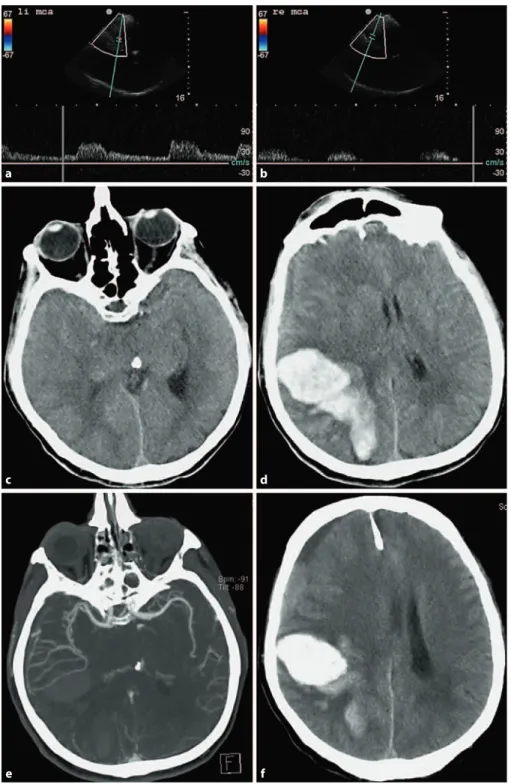 Fig. 4.   Images obtained in an 80-year-old  patient with acute left-sided hemiparesis  and neglect