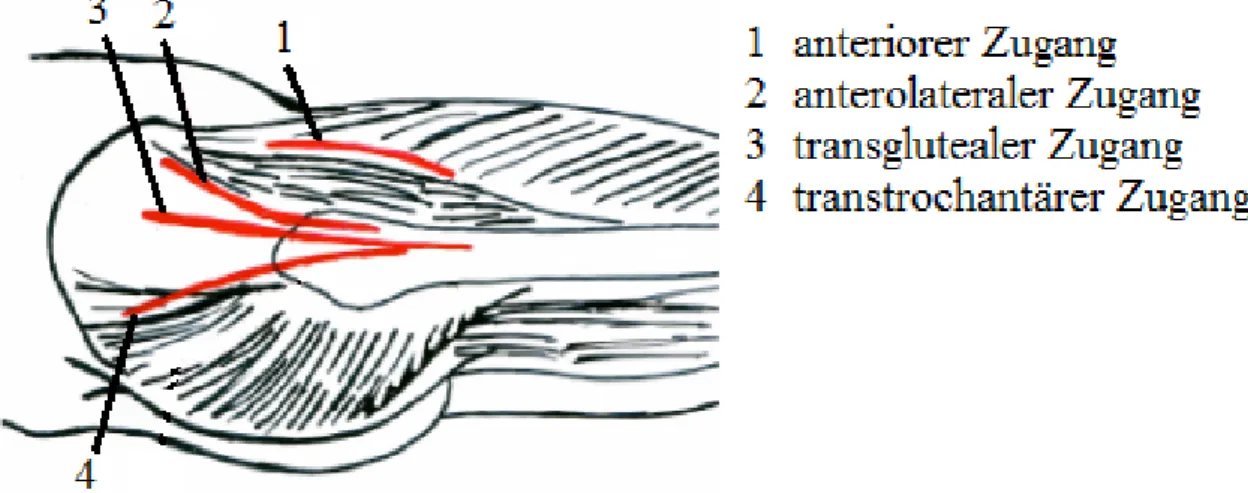 Abb. 1: Zugangswege zum Hüftgelenk, dargestellt in der Sagittalebene 