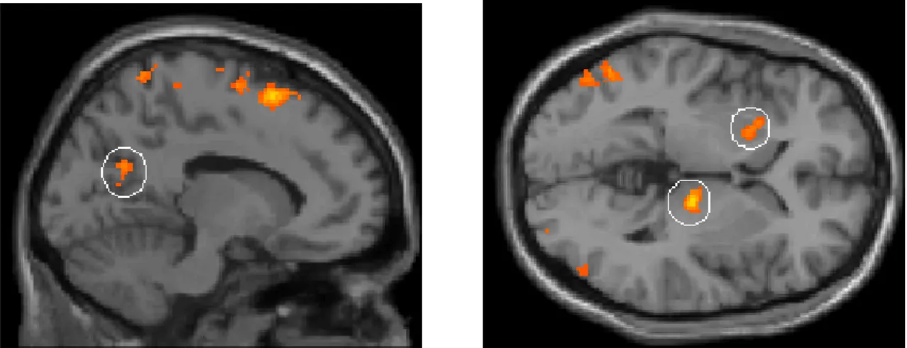 Abb. 3.1: Mehraktivierungen beim Kontrast FB &gt; FR in der Aufsicht auf das dreidimensional dargestellte Gehirn (links die Areale BA 46, BA 2, BA 5 und BA 37 sowie rechts die Areale BA 37 und BA 6).