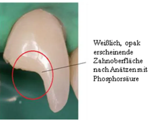 Abb. 12. Beispielhafte Darstellung zur Veranschaulichung der Schmelzoberfläche nach  dem Ätzvorgang mit Phosphorsäure (nach M