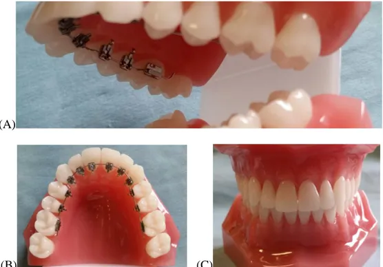 Abb.  15. Die  Lingualtechnik  (A) –  eine  Zahnspange,  die innen befestigt  wird (B) und  von außen nicht sichtbar ist (C)