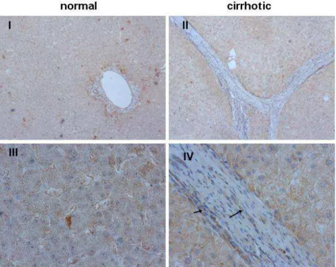 Figure 4.6 Immunohistochemical analysis of FAT1 in normal (panel I, III) and cirrhotic liver tissue  (panel II and IV)