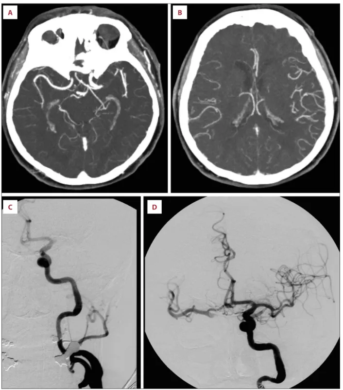 Figure 1.   (A) Maximum intensity projection reconstruction of CT-angiography demonstrates left M1 occlusion 130 minutes after  symptom onset
