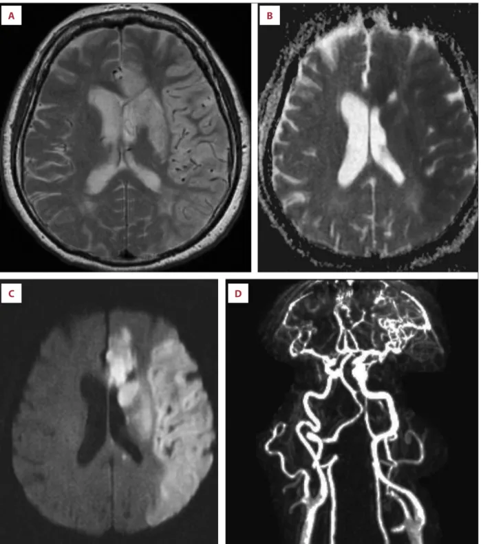 Figure 2.   (A) T2-weighted MRI 6 days later demonstrates partial left ACA ischemia and basal ganglia and a homogenous lesion of left  MCA territory sparing the subcortical white matter
