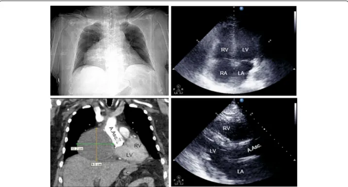 Figure 2 Patient with cardiac tamponade on day 15 after ascending aortic replacement. Right atrial hematoma (102 × 95mm) not detected by transthoracic echocardiography (B-mode: apical 4-chamber-view right above, parasternal long axis right below)