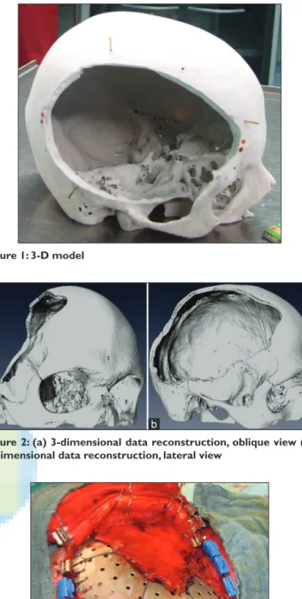 Figure 3: Intraoperative view: Tenting sutures, temporalis muscle  and application of mini screws