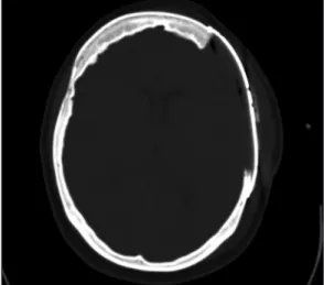 Figure 4: Postoperative CT, axial view displayed accurate fitting of  the titanium plate