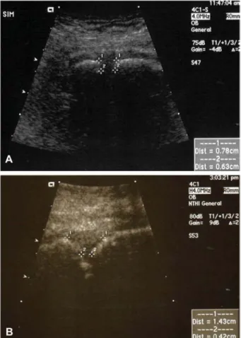 Figure 1 Ultrasonic view of the superior portion of the sym- sym-physis pubis demonstrating the two measurement levels used in the study in a ‘‘T-shaped’’ (A) and a ‘‘Y-shaped’’ (B) superior symphyseal conformation.