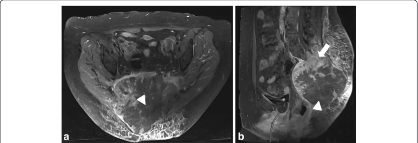 Figure 3 Follow-up postcontrast T1-weighted magnetic resonance images at 24 hours after first intervention