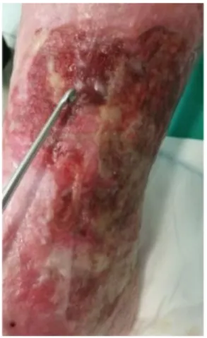 Figure 7 Surgical debridement method using Volkmann spoon. Area subjected to this form of debridement  should be anaesthetized, preferably using occlusive lignocaine dressing