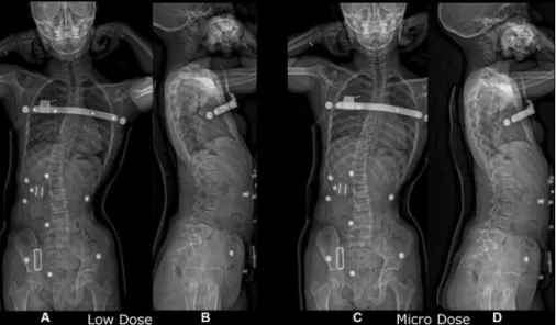 Figuur 3 Vergelijking van scoliose-opnames gemaakt met een bi-planar EOS- EOS-röntgensysteem (A en C achter-voorwaartse opnames, B en D zijwaartse opnames)  gemaakt met lage dosis protocol (A, B) en microdosis protocol (C, D)