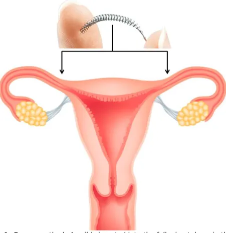 Figure 1: Essure method: A coil is inserted into the fallopian tubes via the cervix  and uterus