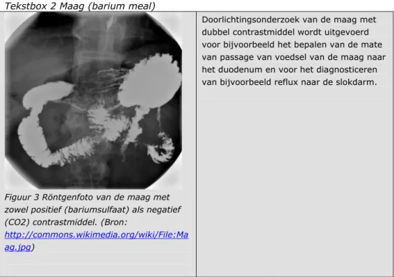 Figuur 4 Röntgenfoto van het abdomen met  nefrolithiasis (niersteen) en een dubbel  J-katheter