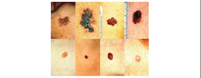 Figuur 6: De verdeling in Breslow-dikte bij de diagnose van een melanoom naar periode van diagnose in zuid- zuid-oost Nederland (12) 