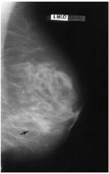 Figuur 7.2: Voorbeeld van een mammogram (bron: NCRP) 