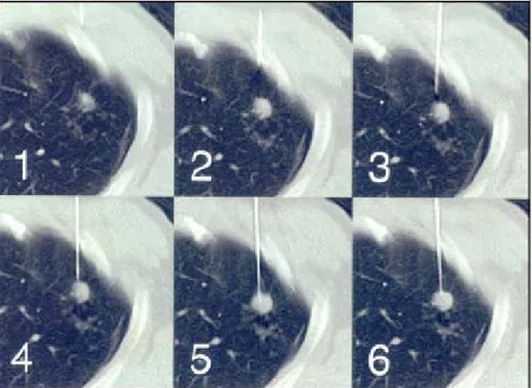 Figuur 2.7:  Voorbeeld van een biopsie met CT-fluoroscopie: van linksboven naar rechts- rechts-onder is te zien hoe de biopsienaald een verdacht plekje aanprikt  (bron: ImPACT)