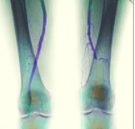 Figure A.2: Peripheral arterial   blockage above the knee 