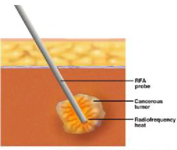 Figure A.4: RFA probe inserted into tumor   to heat and kill tumor. 