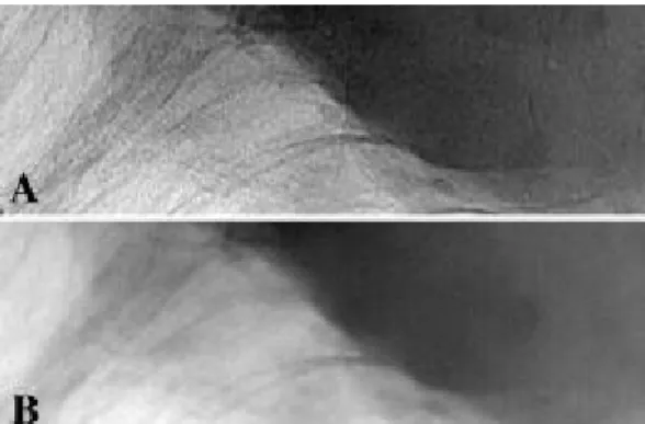 Figure 1: Comparison of phase contrast (A) and absorption X-ray (B) images of  breast tissue containing a malignant mass (darker in the image)