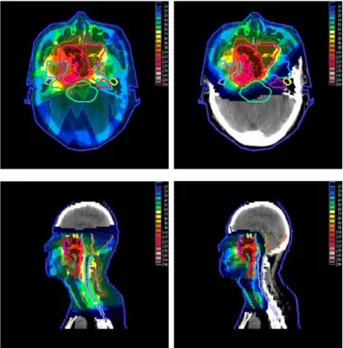 Figure 6: Irradiation of nasopharyngeal carcinoma by X-rays (left) and protons  (right)