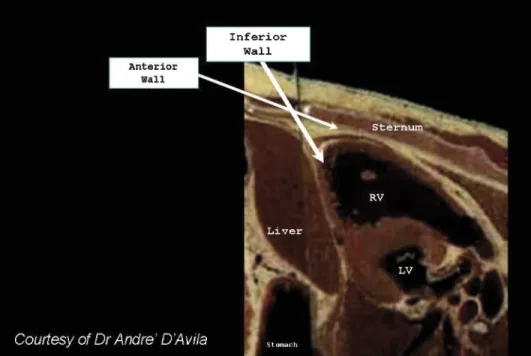 Figure 4 A saggital anatomical cross section showing approaches for percutaneous pericardial entry