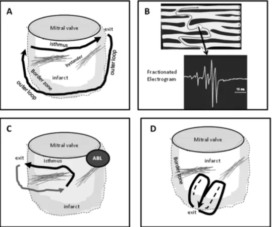Figure 2 Theoretical reentry circuits related to an inferior wall infarct scar are shown