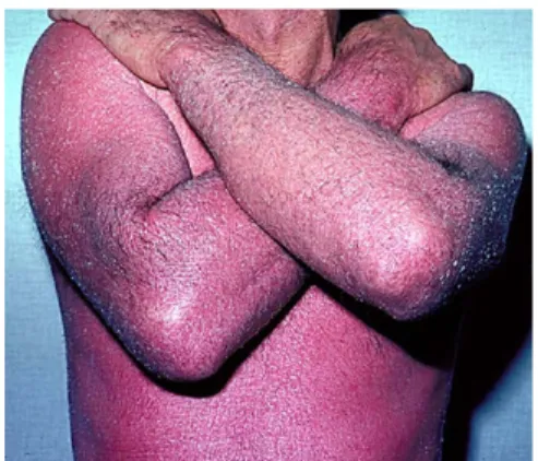 Fig 9. Patient with erythrodermic psoriasis. Generalized inflammatory patches and plaques cover 95% of the BSA.