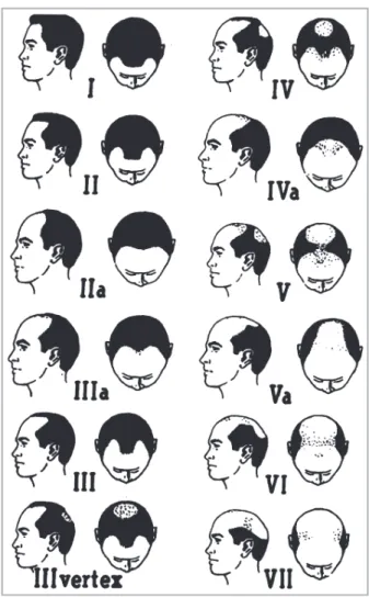 Fig 1. Hamilton–Norwood classification of male balding. 18