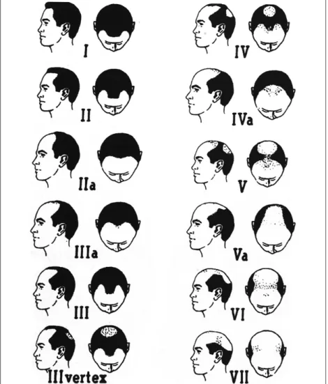 Figure 2: Hamilton-Norwood classification, male pattern (Norwood OT. Male pattern baldness: