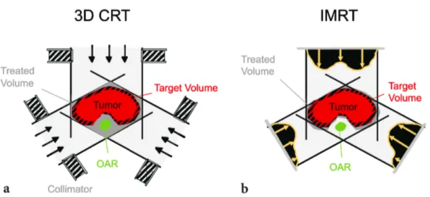 Figure 3 - Comparison of 3D-CRT and IMRT. IMRT provides potential advantages in terms of  sparing the critical structures (shown in green) close to the target volume (shown in red)