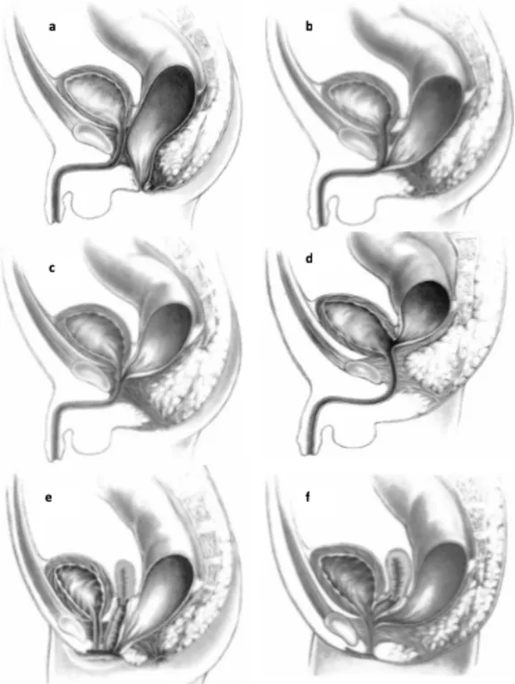 Figuur 1. De verschillende types van anorectale malformaties. (a). Rectoperineale fistel
