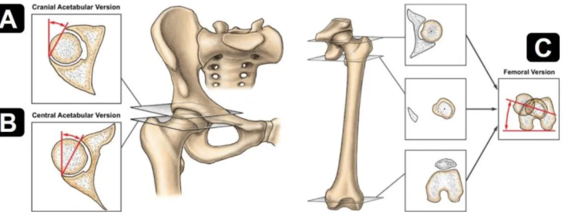 Figure 5. The measurements of the acetabular (A+B) and femoral (C) version angle (from Lerch et al.)  (29)
