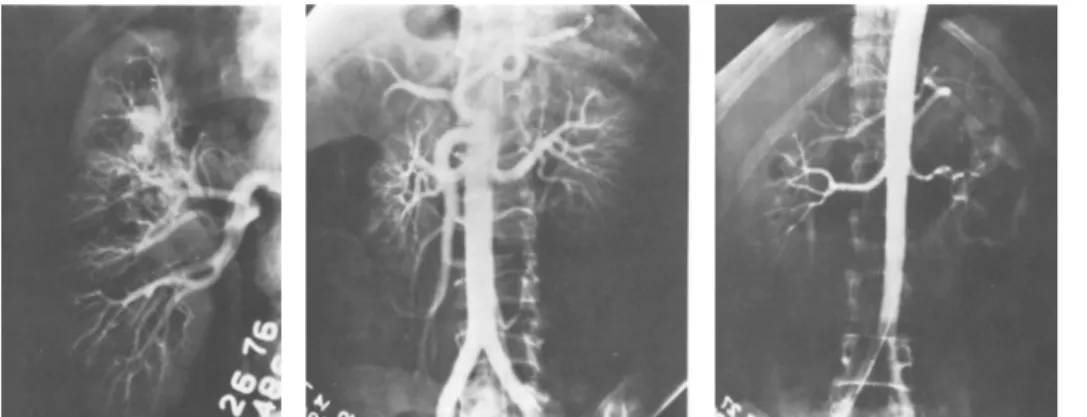 Figure 6: Anatomical variations. Left: a real aneurysm, middle: multiple micro-aneurysms, right: 