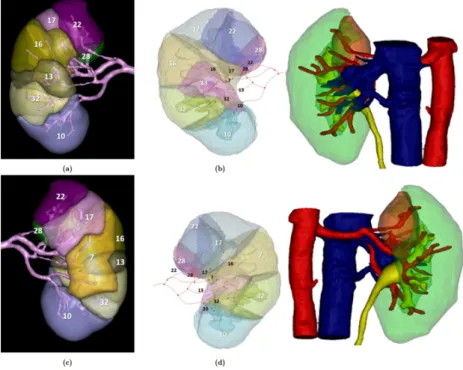 Figure 14: Comparison of the  Visible Patient© tool (left) and  the tool from this study  (middle) and the 3D model as  segmented by M