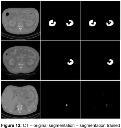 Figure 12: CT – original segmentation – segmentation trained model (55). 