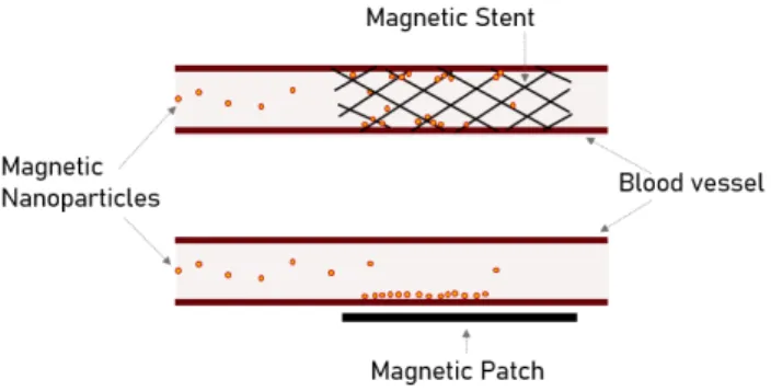 Figure 3.3: Schematic illustration of the use of a magnetic stent versus an impermeable magnetic patch for intravascular IA-MDT.