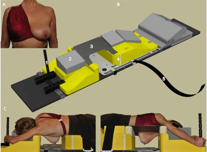 Figure 5. Setup in prone position with the unilateral breast holder (U-BH) (Van de Velde; Schellebelle,  Belgium) and the prone breast board (Orfit Industries; Wijnegem, Belgium)