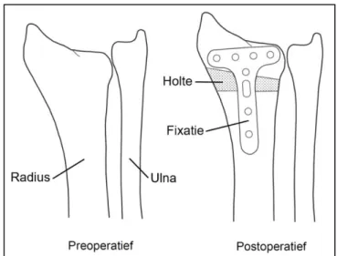 Figuur 6: Lateraal zicht van opening wedge osteotomie bij dorsale malunion van de distale  radius pre- en postoperatief