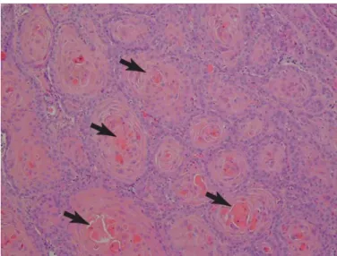 Figuur  6:  Histologisch  beeld  van  een  corneaal  extensief  invasief  SCC.  Neoplastische  cellen  liggen in kringen om heldere eosinofiele keratine  parels  (pijltjes)