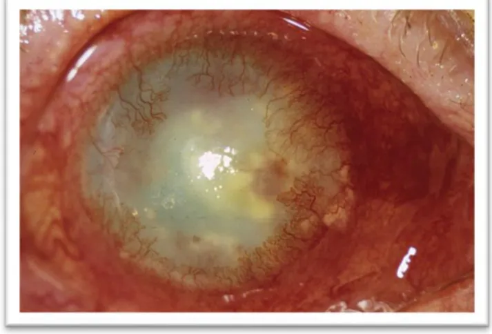 Figuur 5. Close-up van herpes simplex stromale keratitis met duidelijke opacificatie  en neovascularisatie van de cornea